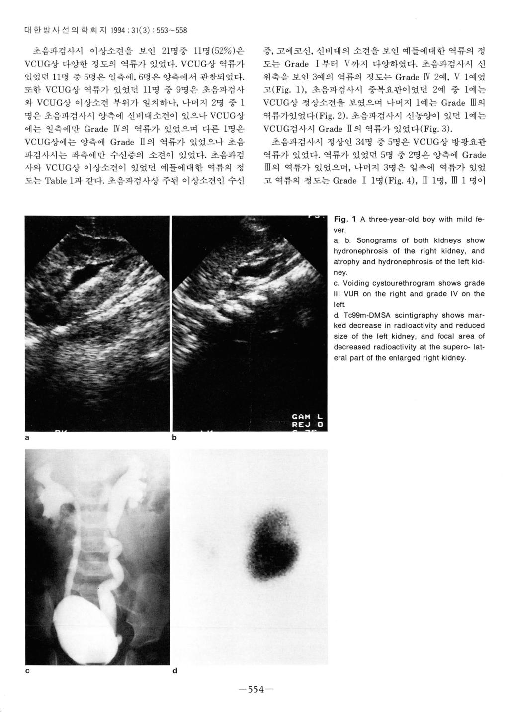 땀대한방사선의학회지 1994; 31 (3) : 553-558 초음파검사시이상소견을보인 21 명중 11 명 (52% ) 은 VCUG상다양한정도의역류가있었다.VCUG상역류가있었던 11 명중 5명은일측에, 6명은양측에서관찰되었다.