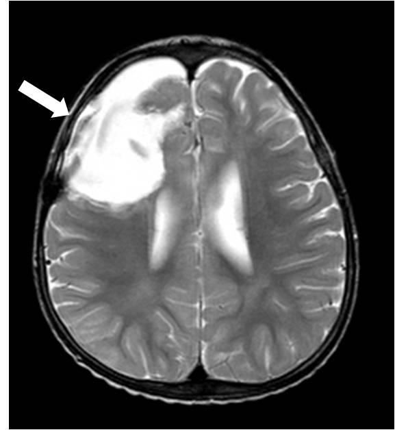 (A) Axial T2W images of patient 1 shows large focal cortical dysplasia (35 23 mm) with probable calcificaiton in right frontal lobe. (B) Axial T2W image shows postoperative change of patient 1.