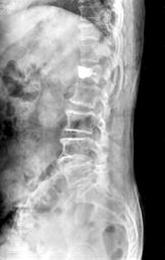 severe back pain and paraparesis that developed one month after kyphoplasty. (A) Post-trauma lateral radiograph.
