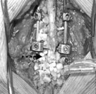 transpedicular intracoporeal corpectomy and rods fixation (long arrow) and