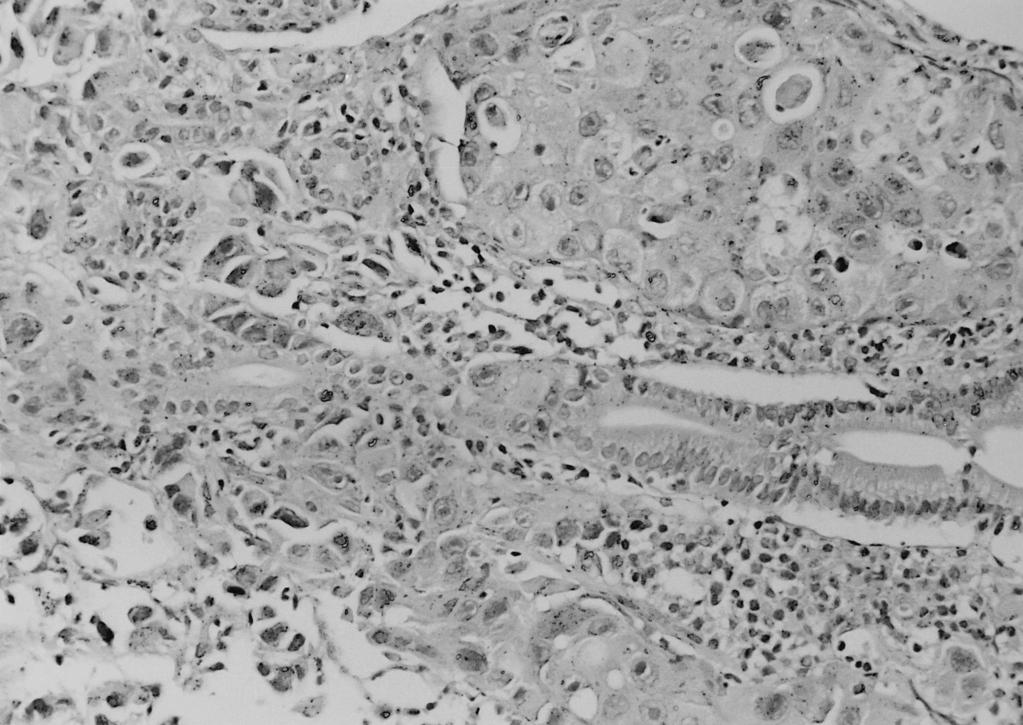 T umor cells are same histologic features w ith lung tumor(h&e, 100). 에 0.4 0.4cm 크기의 용종이 관찰되어 조직생검을 시행 뼈 등의 순이며, 본 증례와 같이 원발성 폐암이 십이지 하였다(Figure 3). 제 5병일째 흉부 단층 촬영하에 경피 장으로 전이된 경우는 매우 드문 것으로 되어 있다.