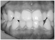 2 a) Gingival hyperpigmentation on Mx. & Mn. Ant.