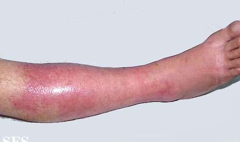 연부조직감염 Skin & soft tissue infection Cellulitis Erysipelas Organism