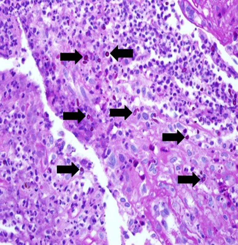 Microscopically, the skin biopsy showed small round microorganisms.