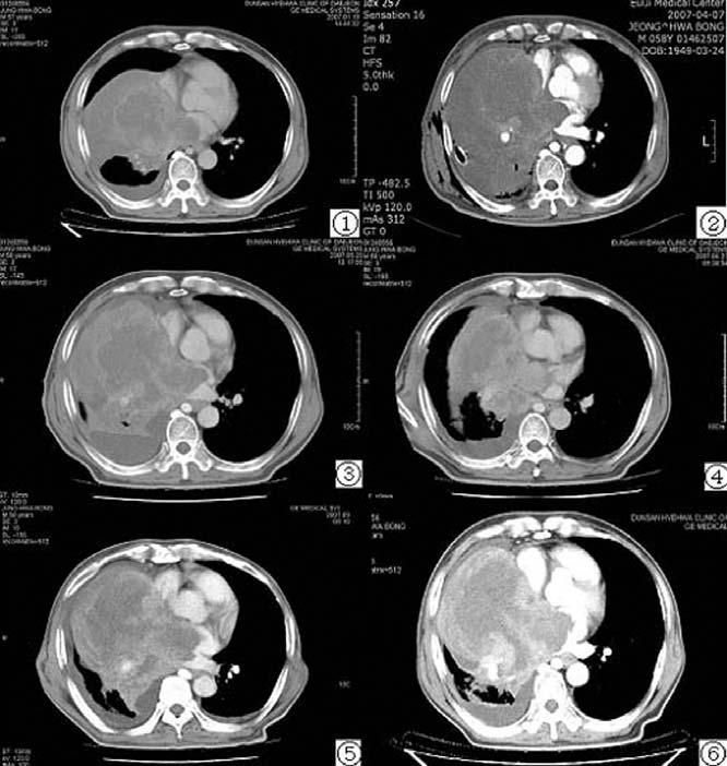 10ml qd Zhongfu (LU 1) Fig. 1 Pathological slide of squamous lung carcinoma ( X 200 ) Fig.