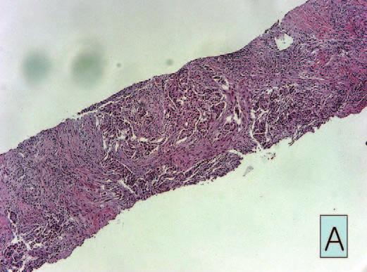 lesion with both mediastinal and both