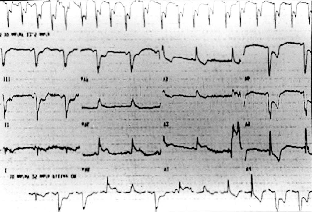 유발을 시도하였으나 심전도에서 변화는 없었으며, 흉 통도 호소하지 않았다. Modified Bruce protocol로 stage Ⅱ로 진행 중에 환자가 갑자기 심한 흉통을 호 소하고 심전도상(Fig. 5) 여러 유도에 걸쳐 심한 ST절 의 상승을 보였다.