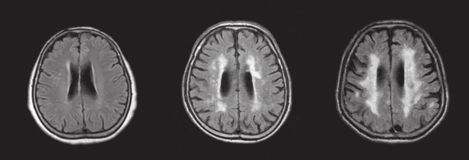우선 DWM을기준으로피질하고신호병변의방향에관계없이가장긴직경을기준으로 D1: 10 mm 미만, D2: 10-24 mm 사이, D3: 25 mm 이상으로나누었다. DWM을 PVWM과구분하기위하여뇌실가쪽벽쪽 (lateral side) 으로정상백질이존재하여야하며마지막뇌실이보인 MRI의두번째상방영상부터측정하였다.
