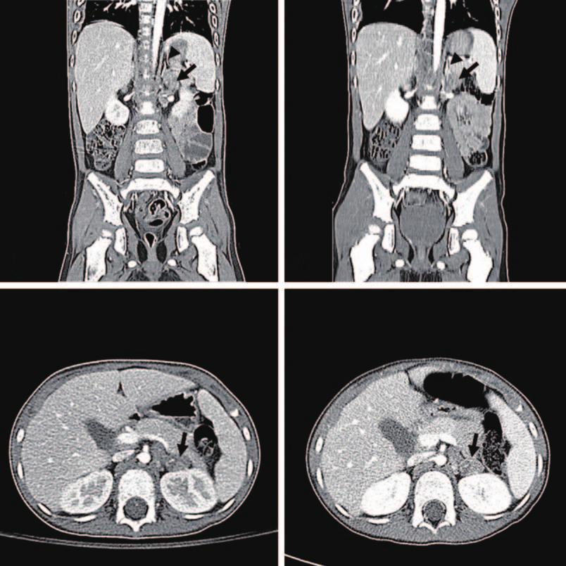 Pediatr Emerg Med J 2016;3(2):59-64 3주전, 우측고관절및복부통증이발생하여외부병원에입원했다. 당시복부컴퓨터단층촬영판독결과특이소견이없었지만, 골반자기공명영상에서양측골반및대퇴골근위부의다발성골병소를근거로급성골수염으로진단되었다. 이후항생제치료에도불구하고좌측고관절의통증과발열이동반하며증상이악화했다.