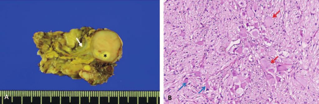 Positron emission tomography (A), positron emission tomography/computed tomography (B), and bone scintigraphy (C: early; D: delayed) showing disseminated metastasis to the bone and bone marrow.