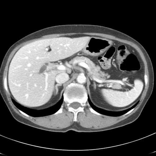 - The Korean Journal of Medicine: Vol. 80, Suppl. 2, 2011 - 에서는담낭에서 1예보고된바있다 [12]. 간외담관에서발생한경우는 Sato 등이발표한총담관의대세포신경내분비종양과선암이혼합된 1예 [13] 외에는발표된적이없다.