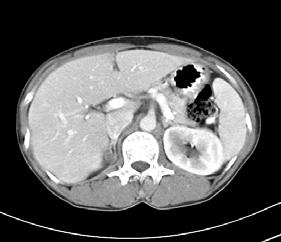 I-131 cholesterol (NP-59) scan에서전신영상및정적영상에서우측간엽하부에국소적동위원소섭취가증가하는소견이관찰되며이는 5일과 7일째영상에서더욱뚜렷해지는소견을보여, 우측부신에 ACTH와독립적인선종소견을보였다 ( 그림 2).