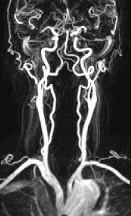 (A) No significant high signal densities in both periventricular white matter are seen on the flare image.