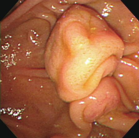 Endoscopic appearance of various ampullary tumors.