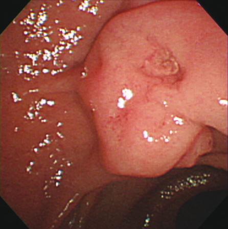(C) Separate orifice of bile duct and pancreatic