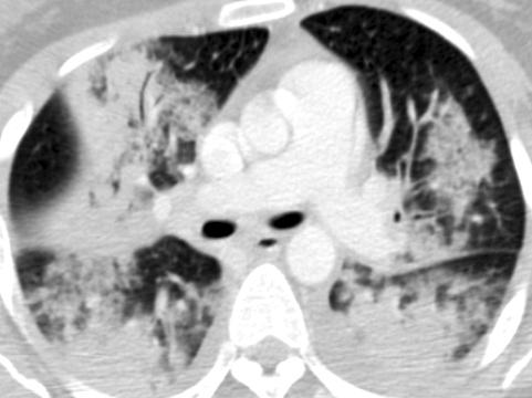 lobar consolidation in right upper and left lower lung field