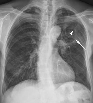 JY Choi et al: A case of Triple Primary Cancers in Stomach, Larynx, and Lung Figure 1. (A) Chest PA view shows about 5.