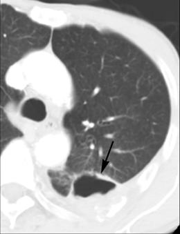 7 cm sized thin walled cavitary mass (arrow) abutting posterior costal pleura in left lower lobe with adjacent focal ground glass attenuated lesion.