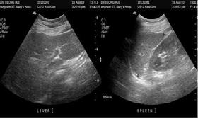 - 대한내과학회지 : 제 70 권부록 2 호 2006 - Figure 1. Abdominal sonography showed a mild coarse and increased echogenicity without an evidence of intrahepatic or extrahepatic bile duct dilatation.