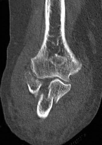 많은연구에서주관절복합골절 - 탈구에서중요한오구돌기골절을간과하지말것을강조한다 (Fig. 5). 몬테지아유형의손상 몬테지아골절이란 1814 년 Monteggia 30) 에의해처음기술된, 척골간부의골절과요골두의전방탈구가동반된골절이다.