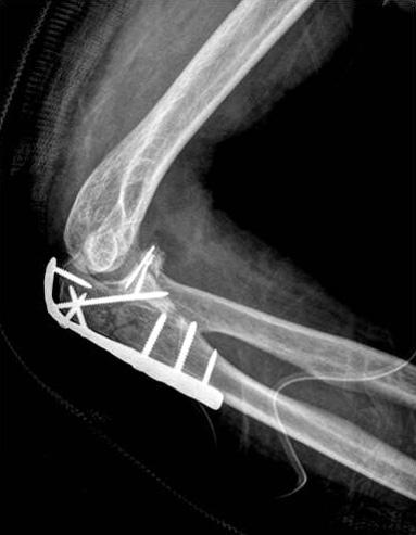 3 차원 CT 에서정확한골절의정도와위치를파악할수있으며, 오구돌기, 요골두, 주두손상정도를정확히알수있다 (Fig. 6). 3. 치료 성인의몬테지아골절은대개수술을요한다. 골절 - 탈구에대해서는일단정복후장상시반석고부목으로고정 Fig. 5.