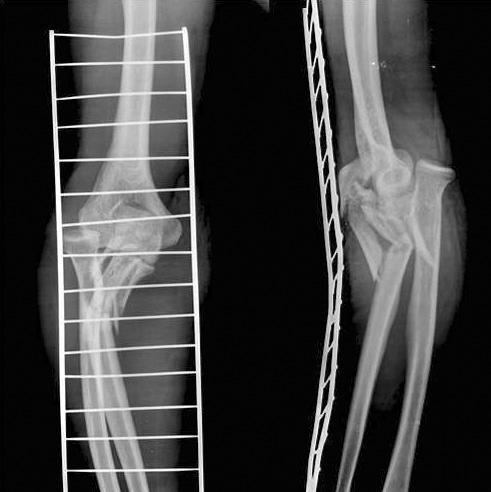 348 신현대, 차수민 Fig. 6. Anteroposterior and lateral radiographs of an elbow fracture-dislocation that inadequately characterized the extent of bony injury.