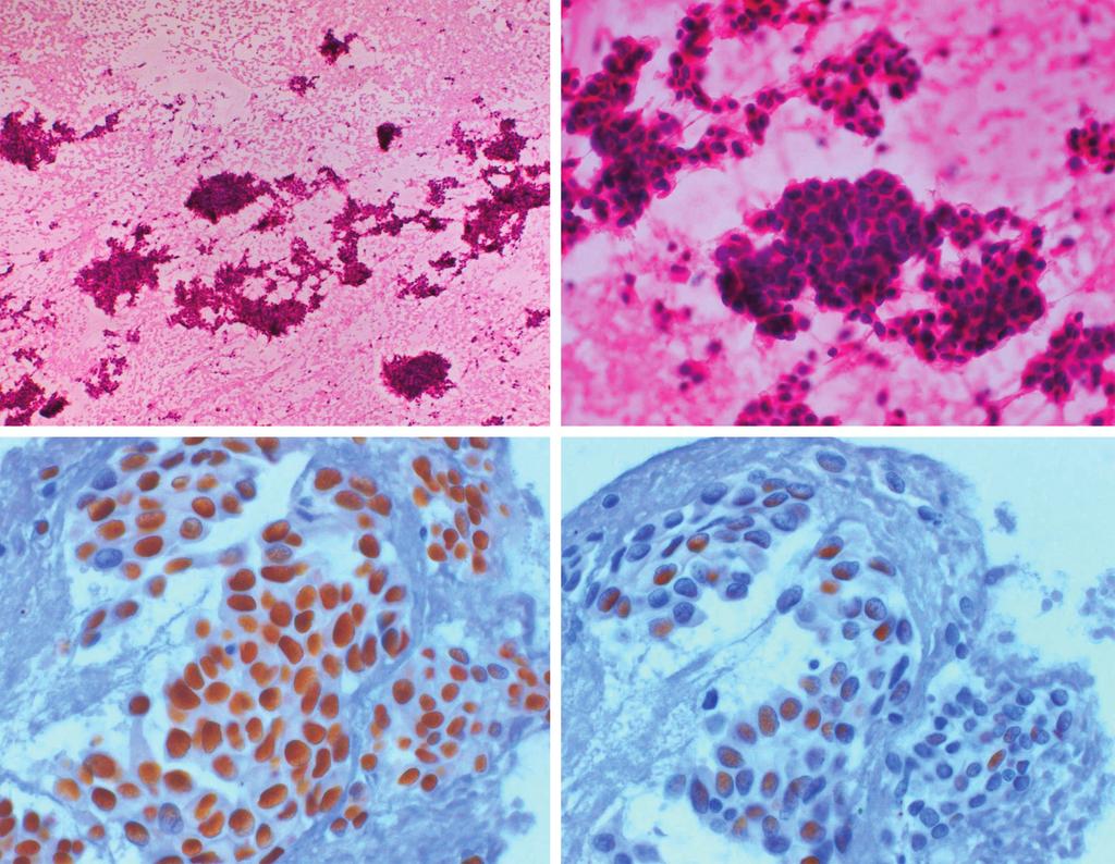 YL Oh : Cytologic Features of Cancers Metastatic to the Lung 는다. 관성형 (duct carcinoma)인 경우 대부분의 경우 군 인 경우 TTF-1염색을 시행하여 양성의 결과를 얻으면 유 집을 이루고 가끔 유두상 구조를 보이며 개개로 흩어지는 방암보다는 원발성 폐암종으로 진단할 수 있다.