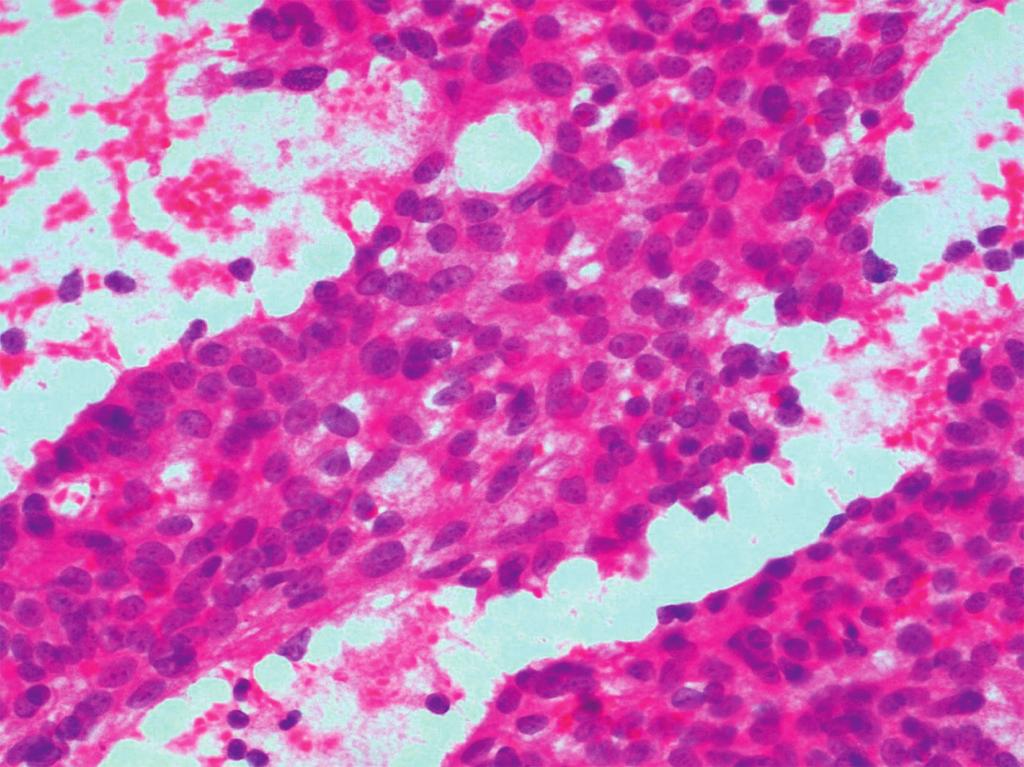 YL Oh : Cytologic Features of Cancers Metastatic to the Lung Fig. 4. Metastatic prostatic adenocarcinoma.