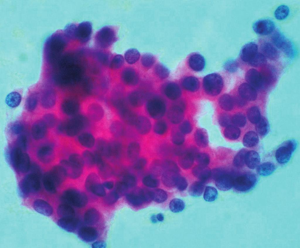(C) Neoplastic cells are positive for PS (Immunohistochemical stain). C 주 나쁜 경우에는 음성일 수 있으니 유의해야 한다.