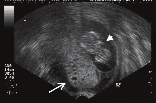 KJOG Vol. 55, No. 6, 2012 Fig. 1. Transavaginal ultrasound imaging demonstrates multicystic hyperechoic mass (arrow) with coexistent living fetus (arrow head). 래에서시행한복부초음파와질초음파에서두정둔부길이 5.