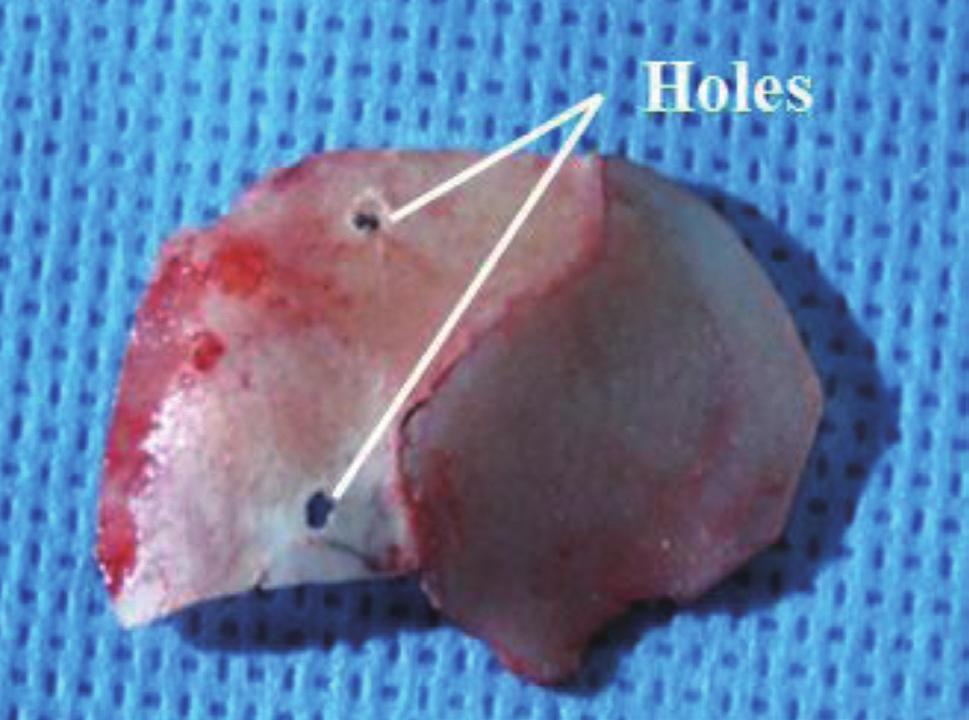 Techniques involving use of cartilage-bony septum for septal extension