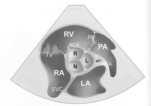 대동맥판수준 (Aortic valve