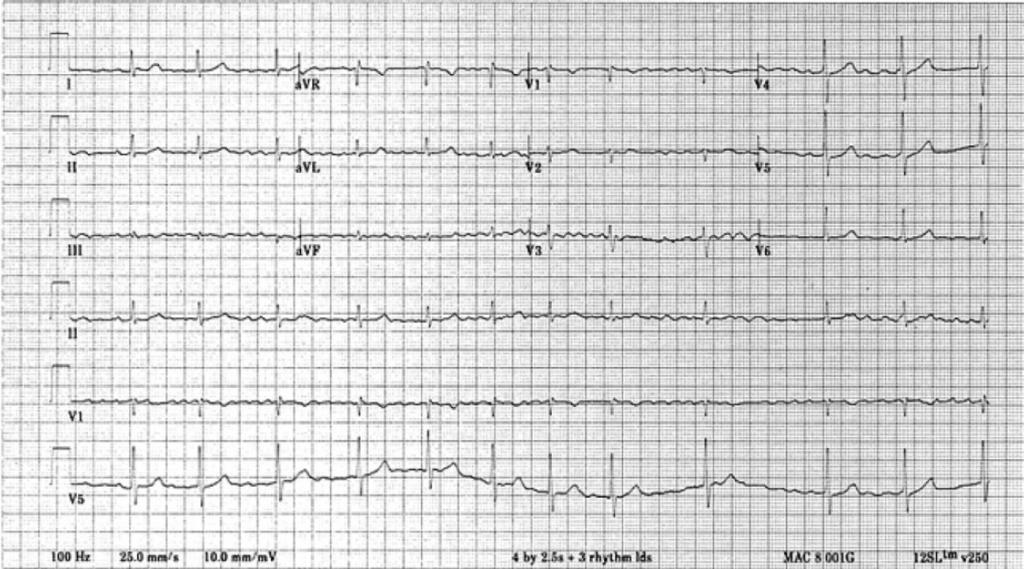 P waves are replaced by fibrillatory waves and the ventricular response is completely irregular.
