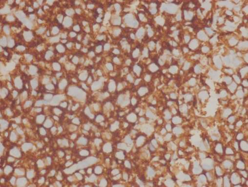 (B) Immunohistochemical stain was positive for CD20 ( 400). (C) Immunohistochemical staining was positive for Ki67 ( 400). A B C Figure 4.