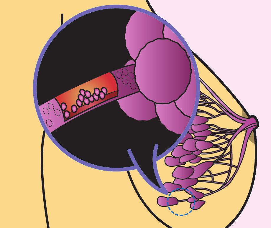유방암이란유방내에발생한종양이유방밖으로퍼져생명을위협할수있는악성종양으로보통유관 ( 젖줄 ) 과유소엽 ( 젖샘 )
