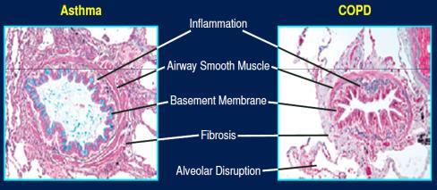 Asthma and COPD Contrasting Histopathology