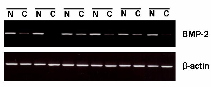 Figure 3. BMP-2 expression in colorectal cancer. The BMP-2 mrna expression level was examined by RT PCR in 40 colorectal cancer cell lines.