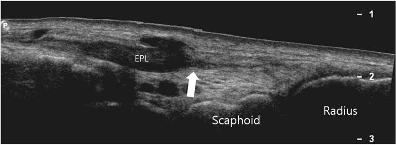 Transverse sonography at the level of distal radius shows empty right