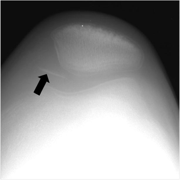 Imaging Diagnosis of Sports Injury Figure 6. patient with transient patellar lateral subluxation.