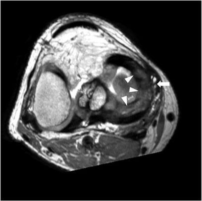 intensity area which extend to inferior articular surface