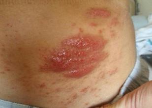 Dermatitis Affected Area