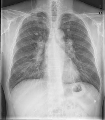 Tuberculosis and Respiratory Diseases Vol. 63. No.2, Aug. 2007 Figure 1. Simple chest radiograph shows prominent both hili and reticular shadow in both lungs at emergency room.