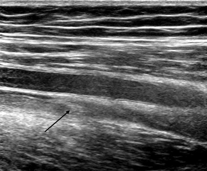 Tuberculosis and Respiratory Diseases Vol. 67. No. 4, Oct. 2009 Figure 2. Doppler ultrasonogram shows echogenic lesion (arrow) in Rt. femoral vein (A) and no blood flow in same lesion (B).