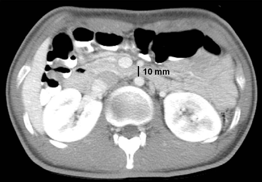 대한내과학회지: 제 83 권 제 5 호 통권 제 627 호 2012 A B Figure 4. Follow-up computed tomography scan shows that the aorto-mesenteric distance had increased from 4.0 to 10.