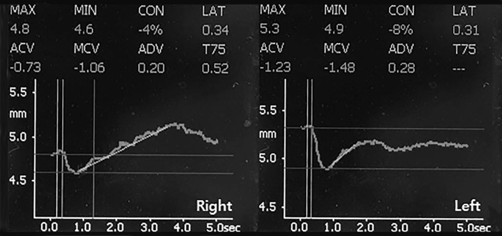 (C) Results of digital pupillometry on initial examination showing decreased constriction (CON) to light. (D) Results of digital pupillometry after instillation of 0.