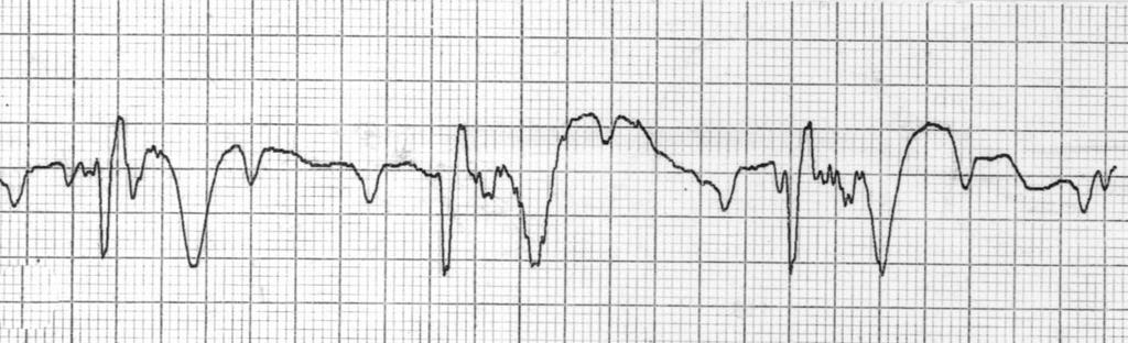 ventricular rhythm of 38 bpm, C follow-up electrocardiogram on 28th postoperative days shows the complete heart block with escape ventricular rhythm of 40 bpm. 로 본원 신경외과에 입원하였다.