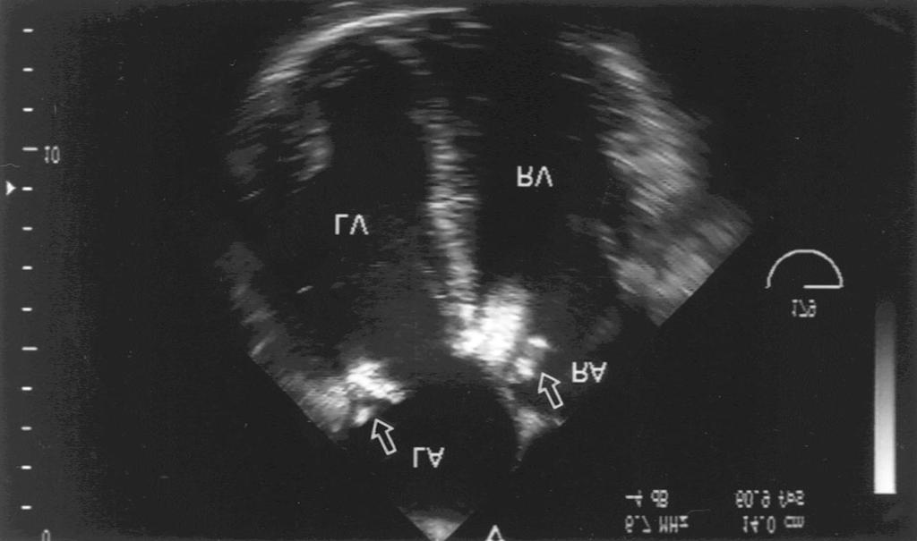 Fig. 2. Transesophageal echocardiogram (179 view) show the vegetations (arrow) in posterior mitral leaflet and lower interatrial septum of right atrium.