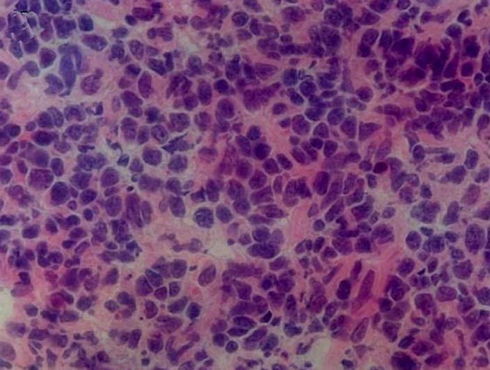 marker)에 음성반응을 보여 미만성 거대 B 세포 고 앞쪽, 아래쪽으로는 심근층과 장막심장막(pericardium (Diffuse large B cell) 림프종으로 진단되었다(Fig. 5B).