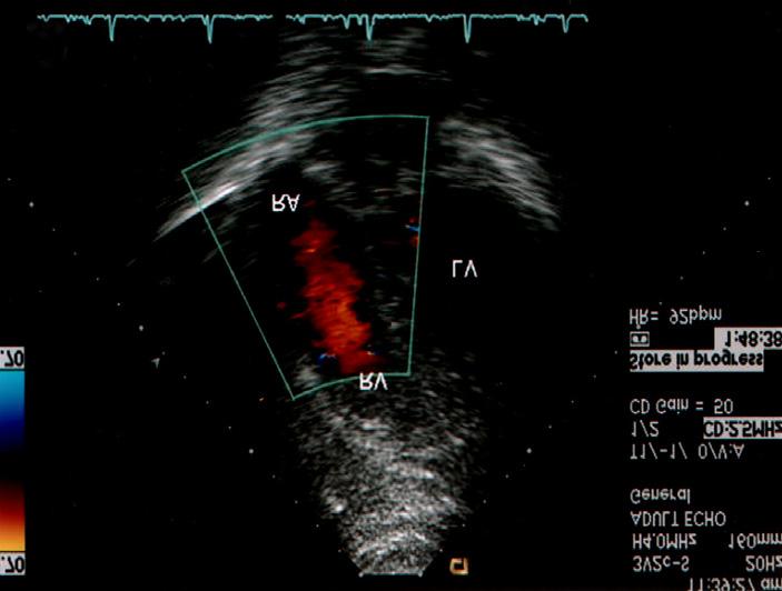 B Fig. 6. : follow up short axis transthoracic echocardiogram after chemo-radiotherapy showing significantly decreased mass (arrows) size.