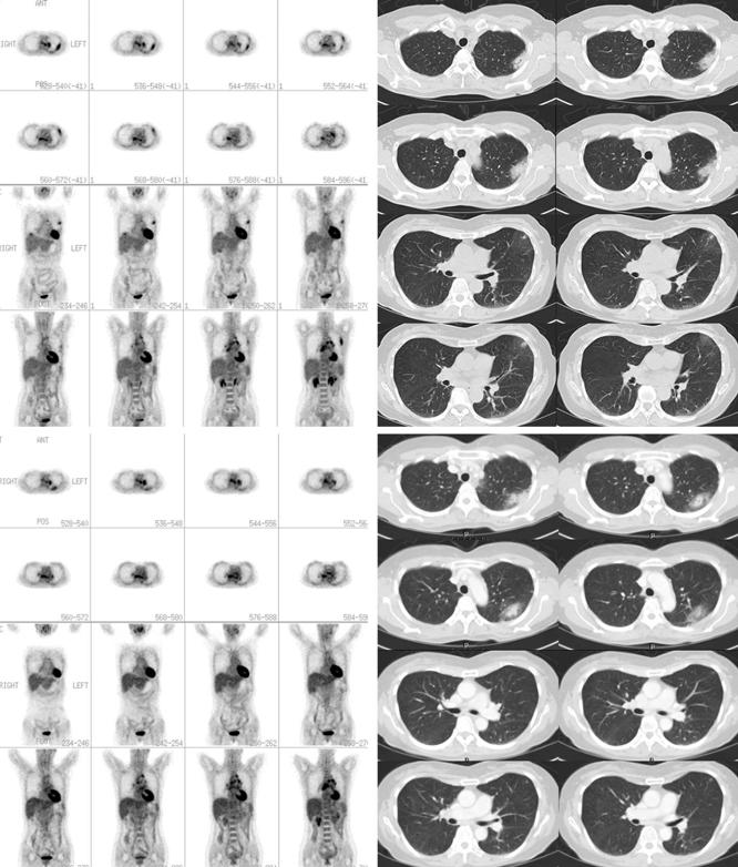 Jae Hoon Lee, et al. F18 FDG PET Scan findings in Patients with Pulmonary Involvement in the Hypereosinophilic Syndrome A B C D Figure 1.